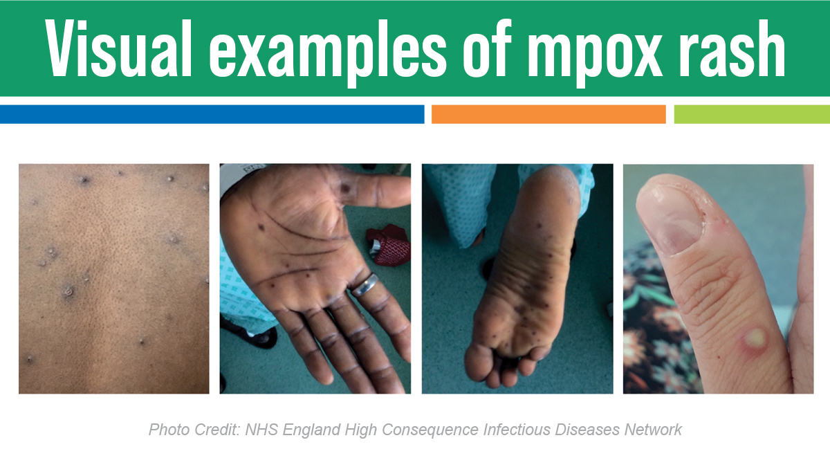 Monkeypox rash